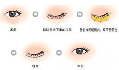 眼袋祛除手术的费用大概需要多少钱?